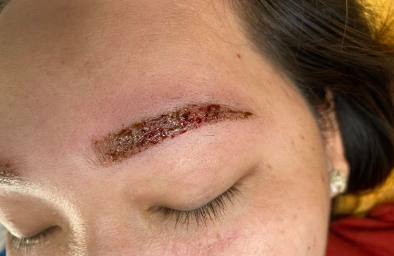 Thăm khám khi thấy chân mày xuất hiện mủ trắng, dịch vàng