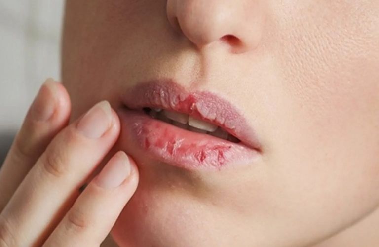 Không tự ý bóc vảy môi