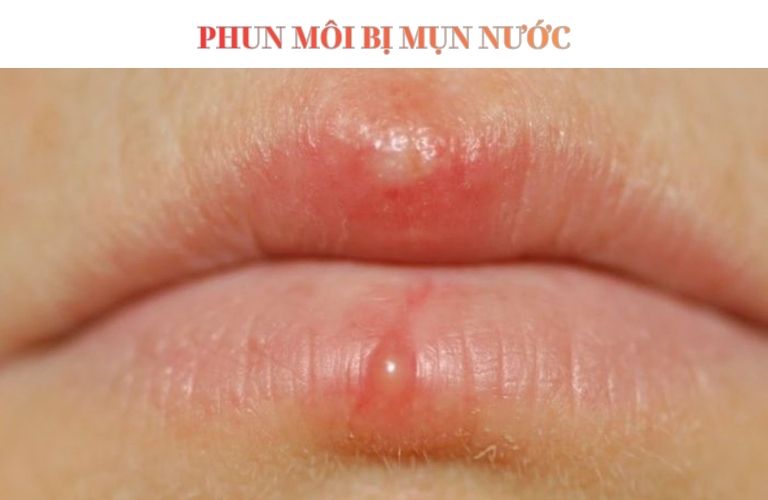 Phun môi bị mụn nước