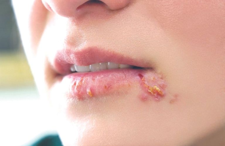 Phun môi bị mụn nước do herpes