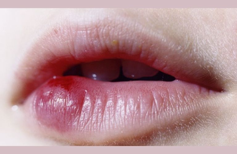 Một số trường hợp phun môi bị mụn nước có thể để lại thâm môi hoặc sẹo nhẹ