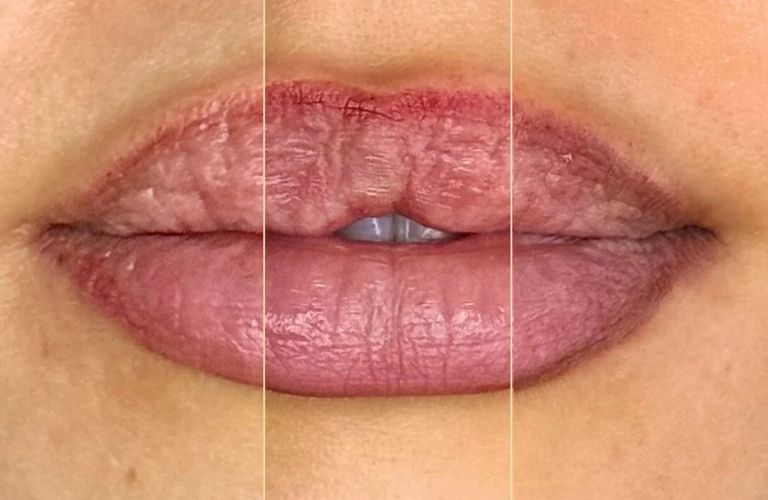 Môi có sự chênh lệch màu sắc rõ rệt, môi không đều màu ở các vị trí là dấu hiệu rõ nét nhất