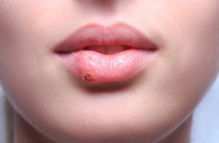 Tăng nguy cơ viêm nhiễm và kích ứng