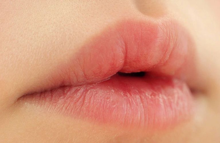 Môi có biểu hiện sưng nhẹ, căng tức và đỏ trong 1 - 3 ngày đầu sau phun