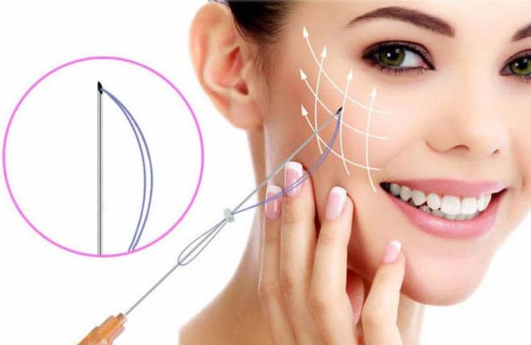 Thẩm mỹ viện Galaxy áp dụng kỹ thuật căng chỉ tiên tiến