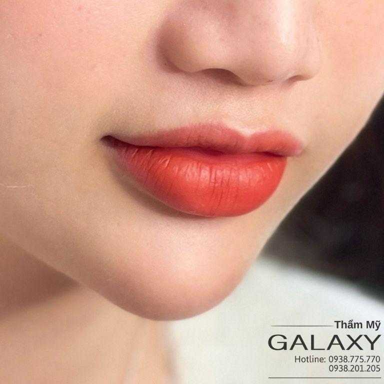 Tiêm filler tại Thẩm mỹ viện Galaxy