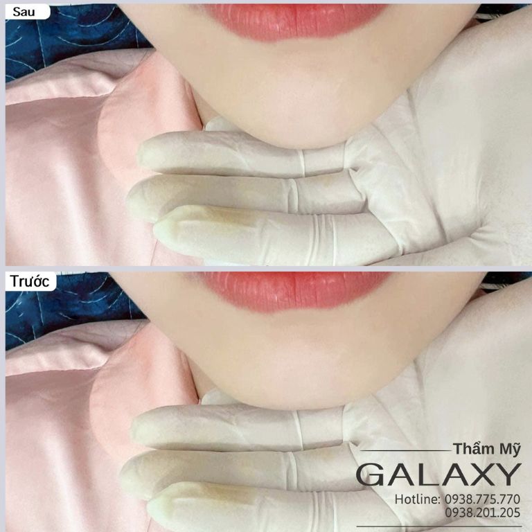 Thẩm mỹ viện Galaxy tiêm filler cằm V-line
