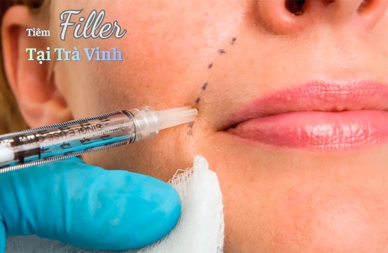 Tiêm filler tại Trà Vinh