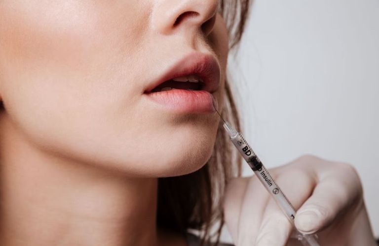 Tiêm môi cánh én có an toàn không còn phụ thuộc vào trình độ chuyên môn của người thực hiện