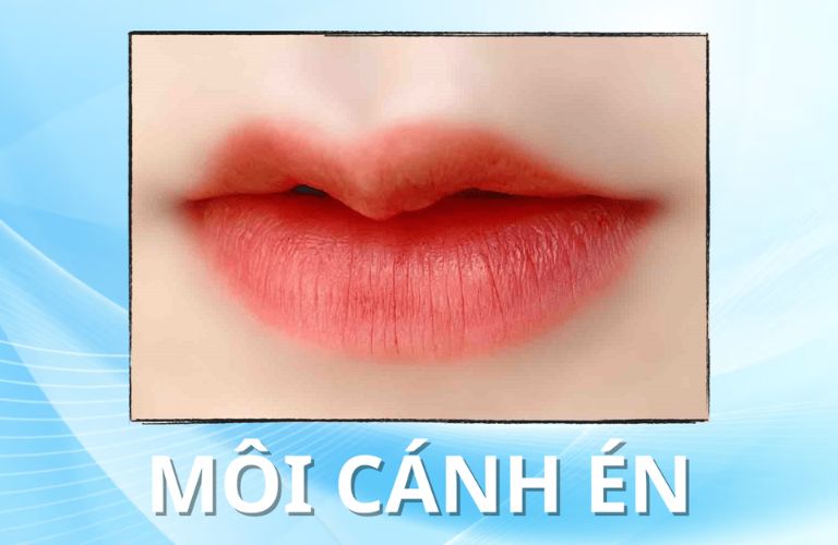 Tiêm môi cánh én