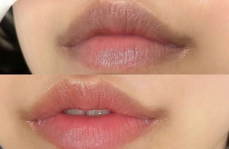 Viền môi bị thâm sau khi xăm xảy ra khi phần ranh giới giữa môi và da mặt trở nên sẫm màu