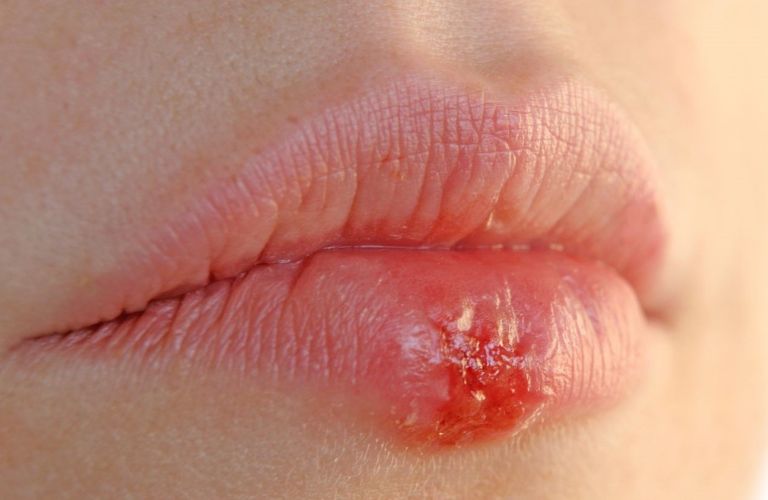 Không nên ăn thịt vịt ngay sau khi xăm môi vì thịt vịt có tính hàn, dễ gây viêm nhiễm