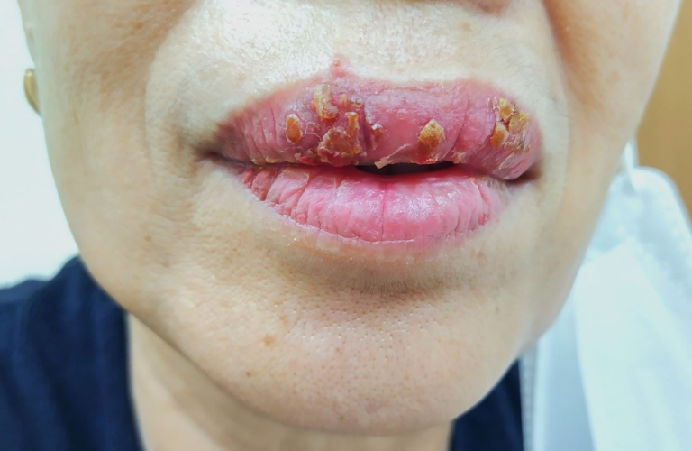 Sưng, đau và chảy máu kéo dài thường là dấu hiệu của viêm nhiễm sau xăm môi