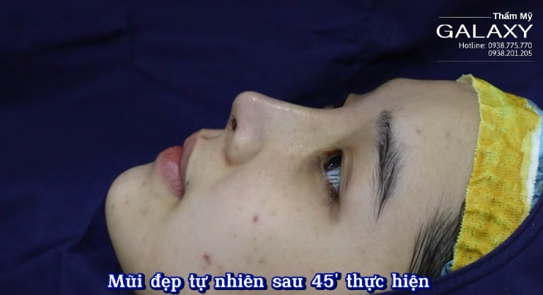 Bác sĩ Lê Trần Duy giải đáp16 tuổi nâng mũi được không