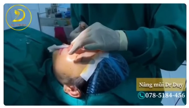 Nâng mũi dáng Thái Lan ở đâu đẹp