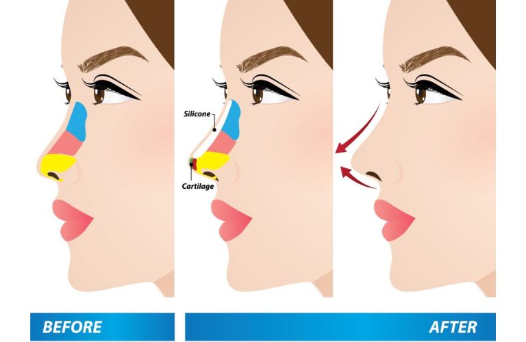 Nâng mũi cấu trúc