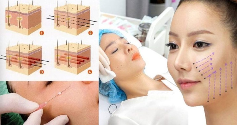 Quy trình căng da mặt 3D