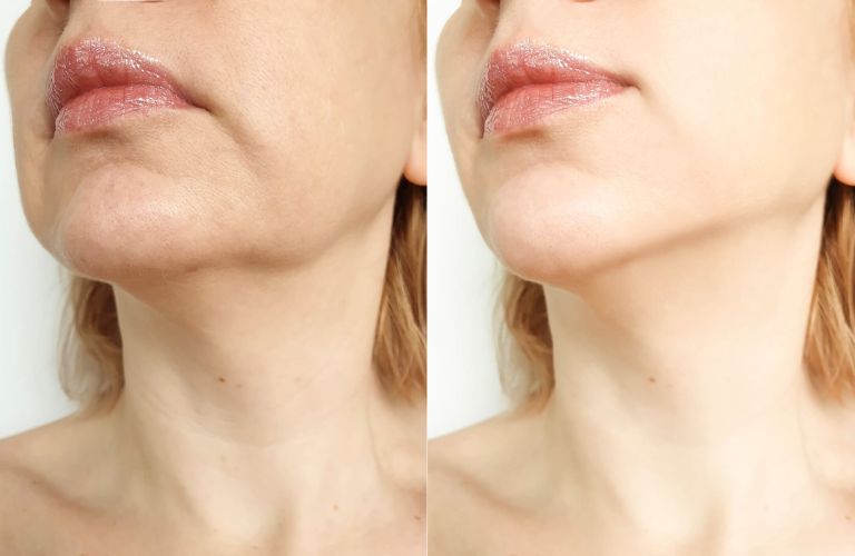 Xóa mờ nếp nhăn và rãnh sâu