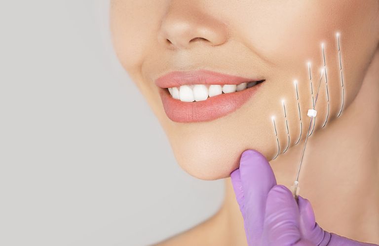 Căng da mặt bán phần bằng chỉ sinh học