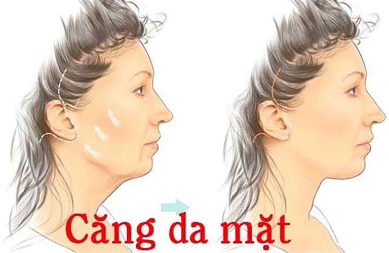 Căng da mặt bán phần bằng phẫu thuật