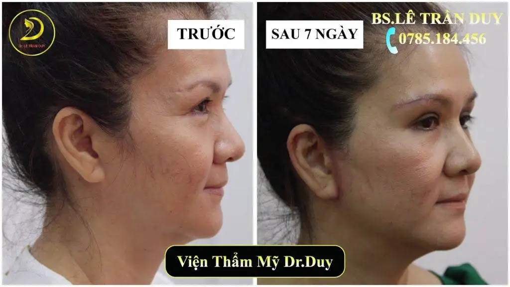Căng da mặt tại Điện Biên