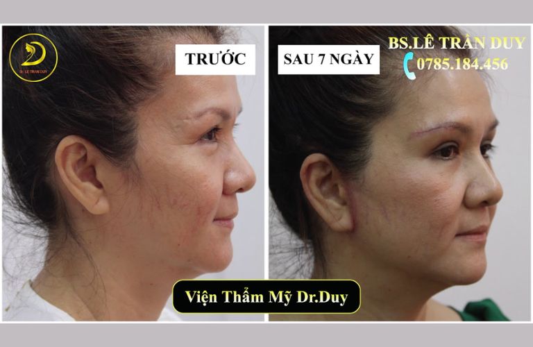 Căng da mặt tại Thẩm mỹ viện Galaxy