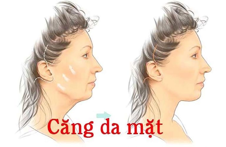 Căng da mặt bằng phương pháp phù hợp