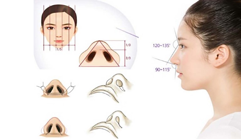 Cắt cánh mũi
