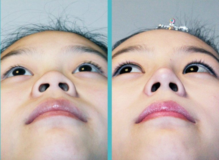 phẫu thuật cắt cánh mũi