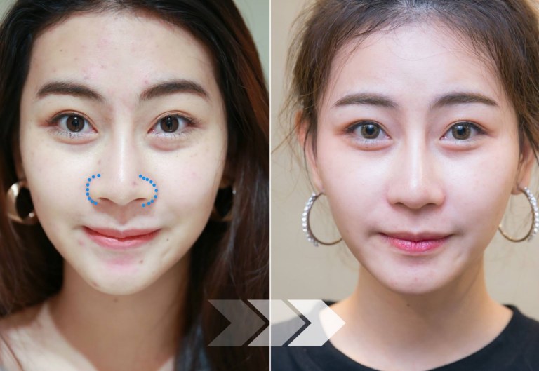 Cắt cánh mũi có được vĩnh viễn không