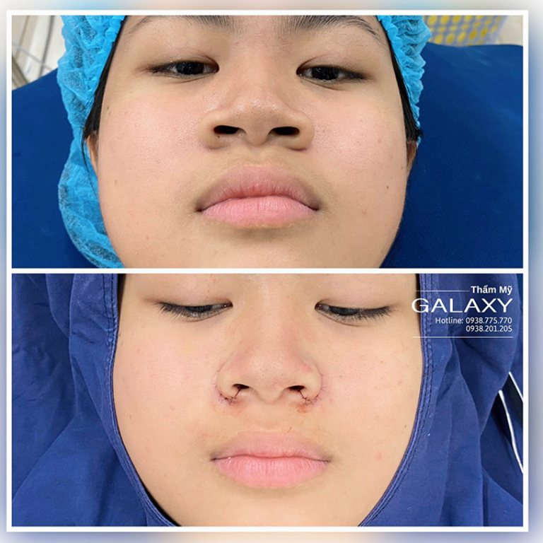Thẩm mỹ Galaxy là địa chỉ cắt cánh mũi đẹp