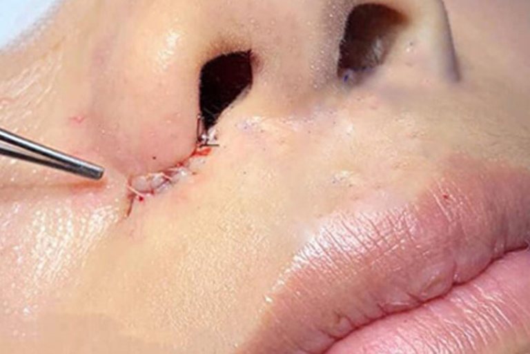 Cắt cánh mũi có để lại sẹo không