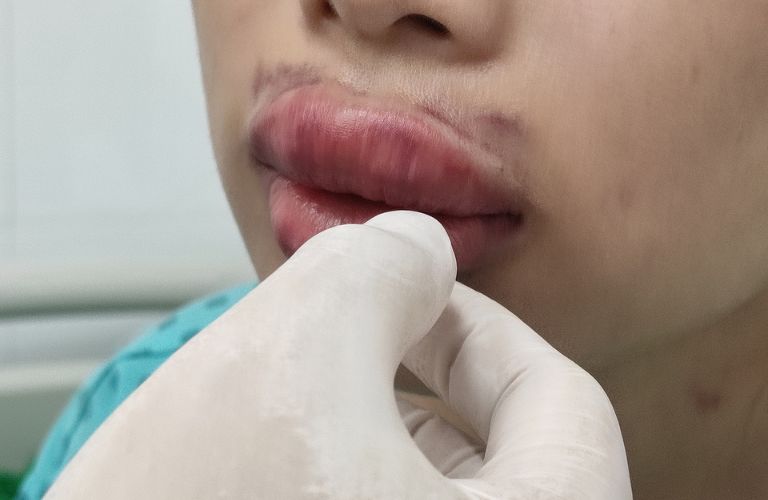 Dấu hiệu tiêm filler bị hoại tử