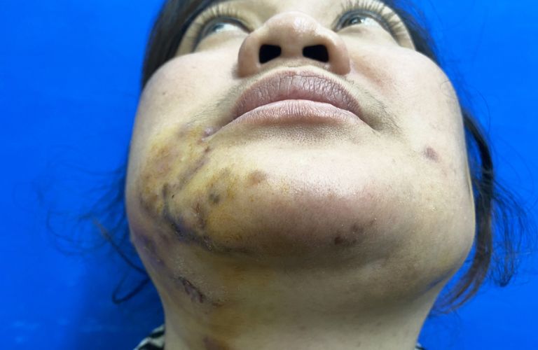 Da thâm đen, mô hoại tử lộ rõ có thể cho biết tình trạng hoại tử sau khi tiêm filler