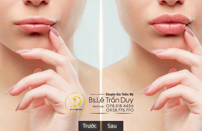 Tiêm filler an toàn, ngăn ngừa tình trạng hoại tử tại Thẩm mỹ viện Galaxy