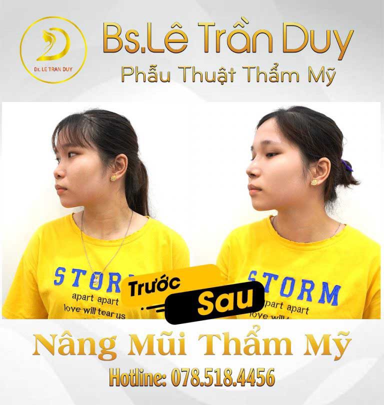 thẩm mỹ bác sĩ Lê Trần Duy nâng mũi tại Cần Thơ