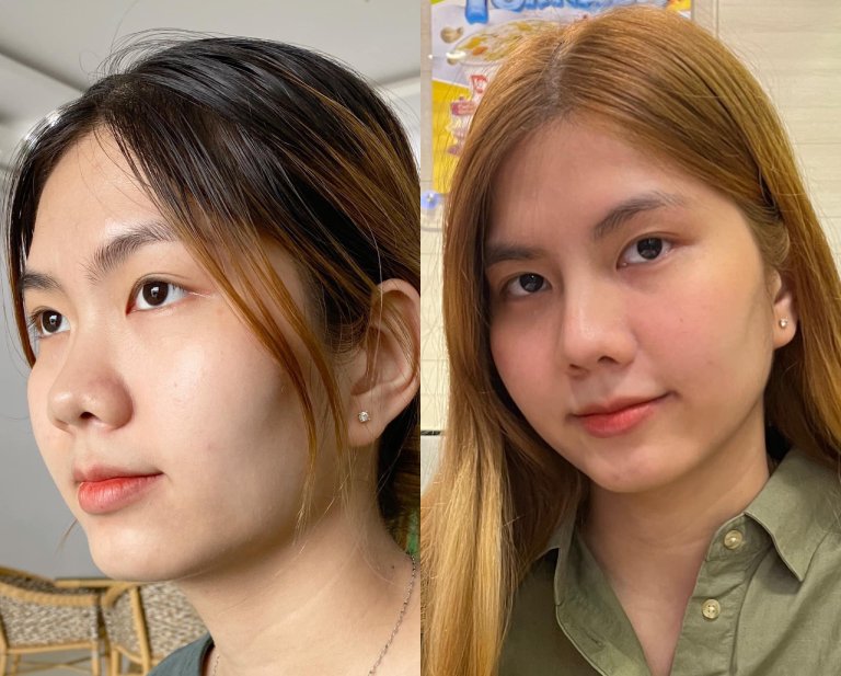 Thẩm Mỹ Viện Thục Đoan nâng mũi ở Đà Nẵng