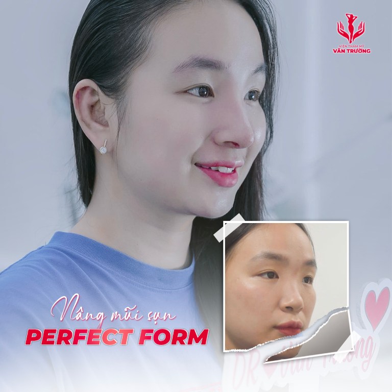 Viện Thẩm Mỹ Văn Trường nâng mũi tại Đà Nẵng
