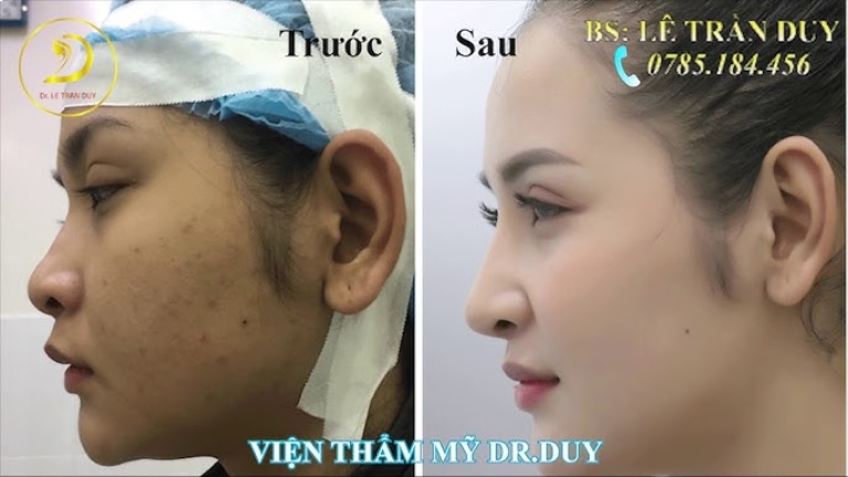 Thẩm mỹ Galaxy là Địa chỉ nâng mũi tại Đà Nẵng uy tín