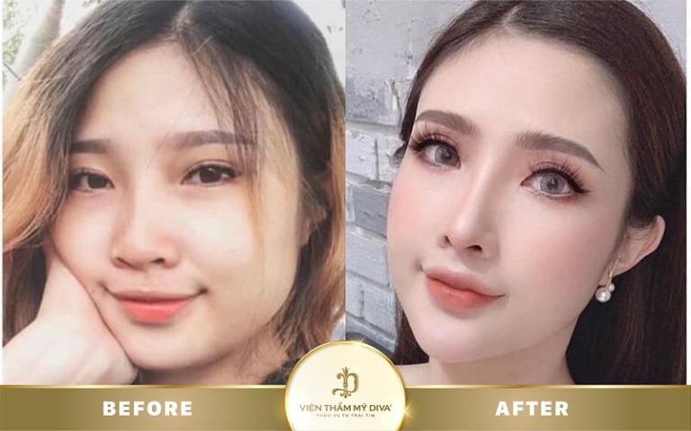 Địa chỉ nâng mũi đẹp tại Dĩ An