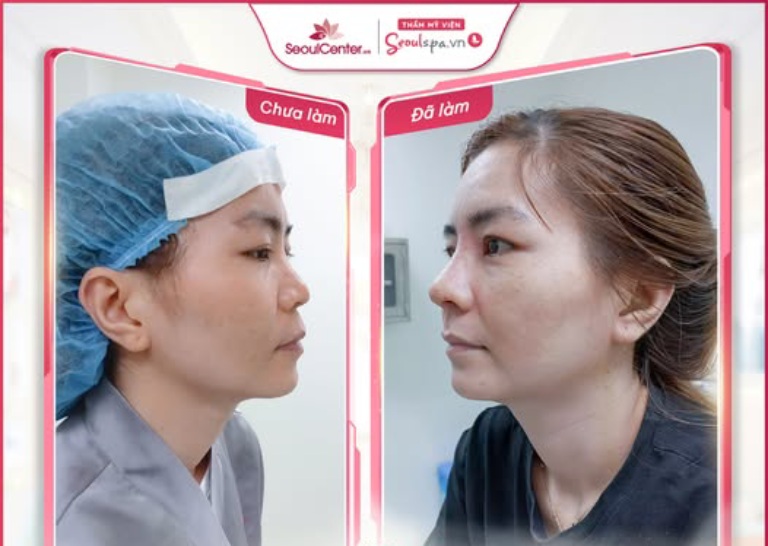 Địa chỉ nâng mũi uy tín tại Dĩ An