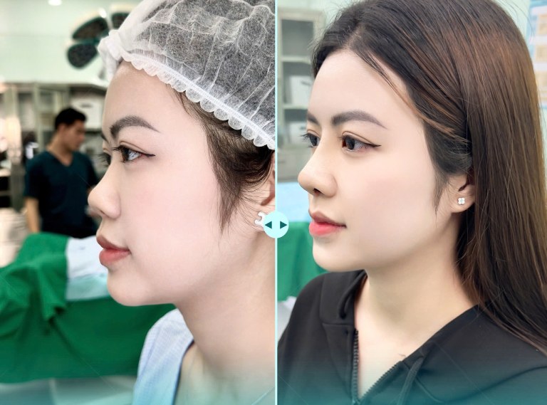Thẩm Mỹ Viện Hường Venus là địa chỉ nâng mũi ở Kon Tum đang được review tốt