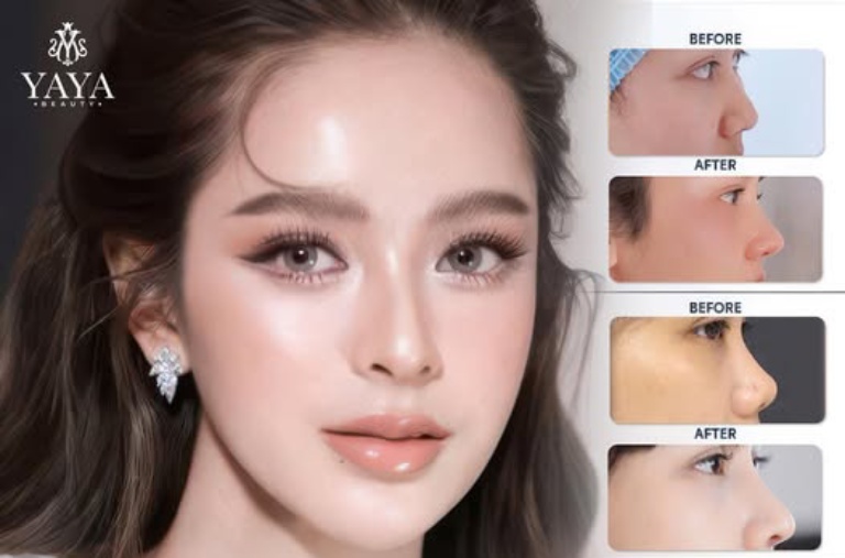 Viện Thẩm Mỹ Yaya Beauty nâng mũi ở Long An