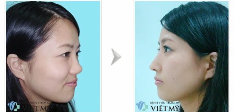 Bệnh viện Thẩm mỹ Việt Mỹ nâng mũi tại quận 1