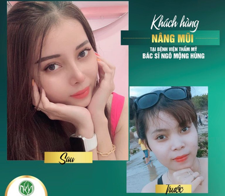 Bệnh viện Thẩm mỹ Ngô Mộng Hùng là địa chỉ nâng mũi ở quận 3 chất lượng