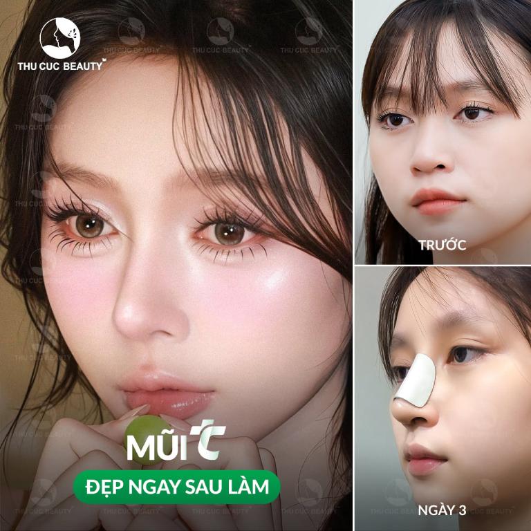 Bệnh viện Thẩm mỹ Thu Cúc nâng mũi tại quận 3