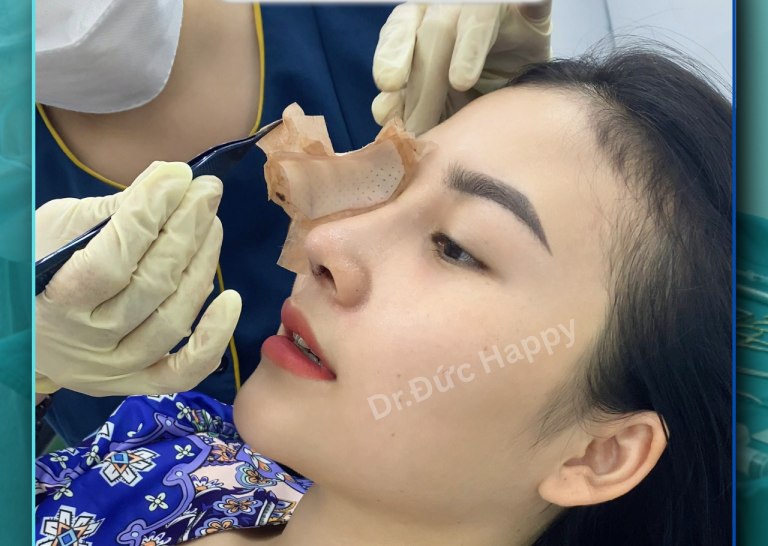Phòng khám Chuyên khoa Thẩm mỹ Happy nâng mũi tại quận 3
