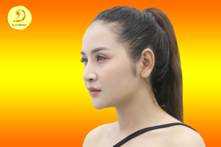 Địa chỉ nâng mũi tại Sóc Trăng