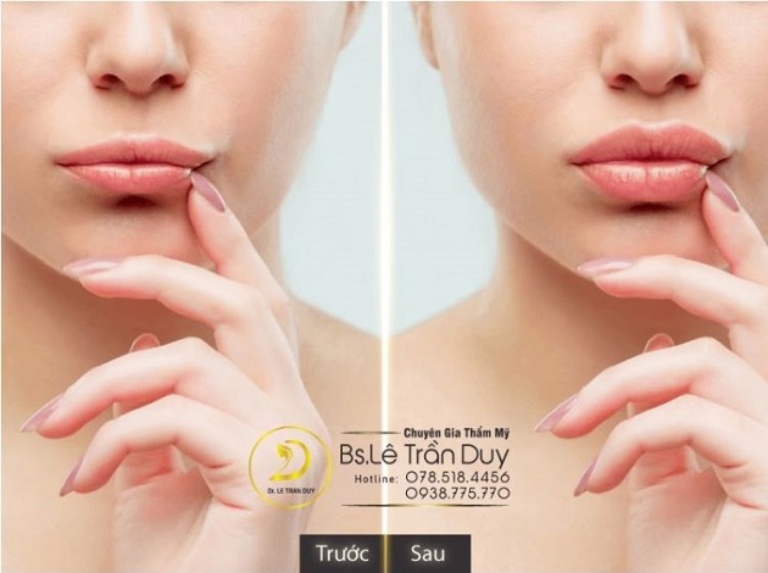 Bác sĩ Lê Trần Duy tư vấn phụ nữ cho con bú tiêm Filler có sao không