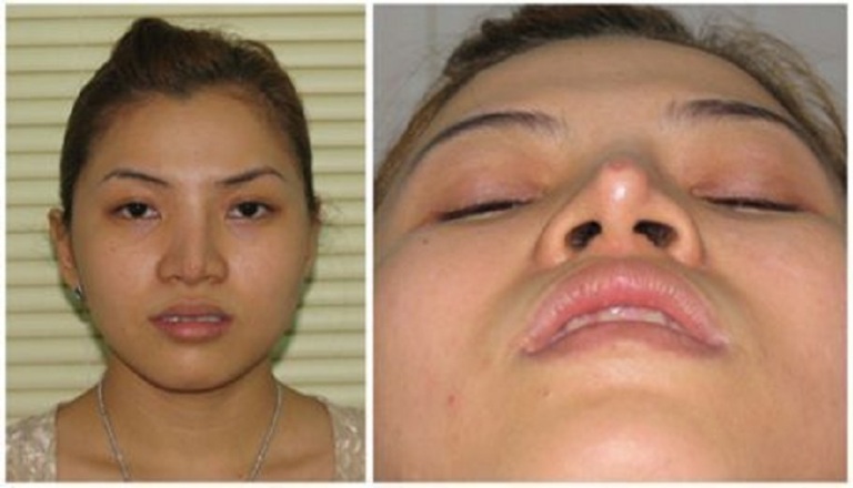 Dấu hiệu mũi bị tụt sụn